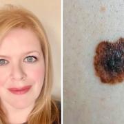 Wirral woman’s warning after ‘brown mark’ on back led to skin cancer diagnosis